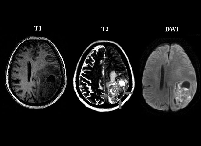 Радиология: случай глиосаркомы