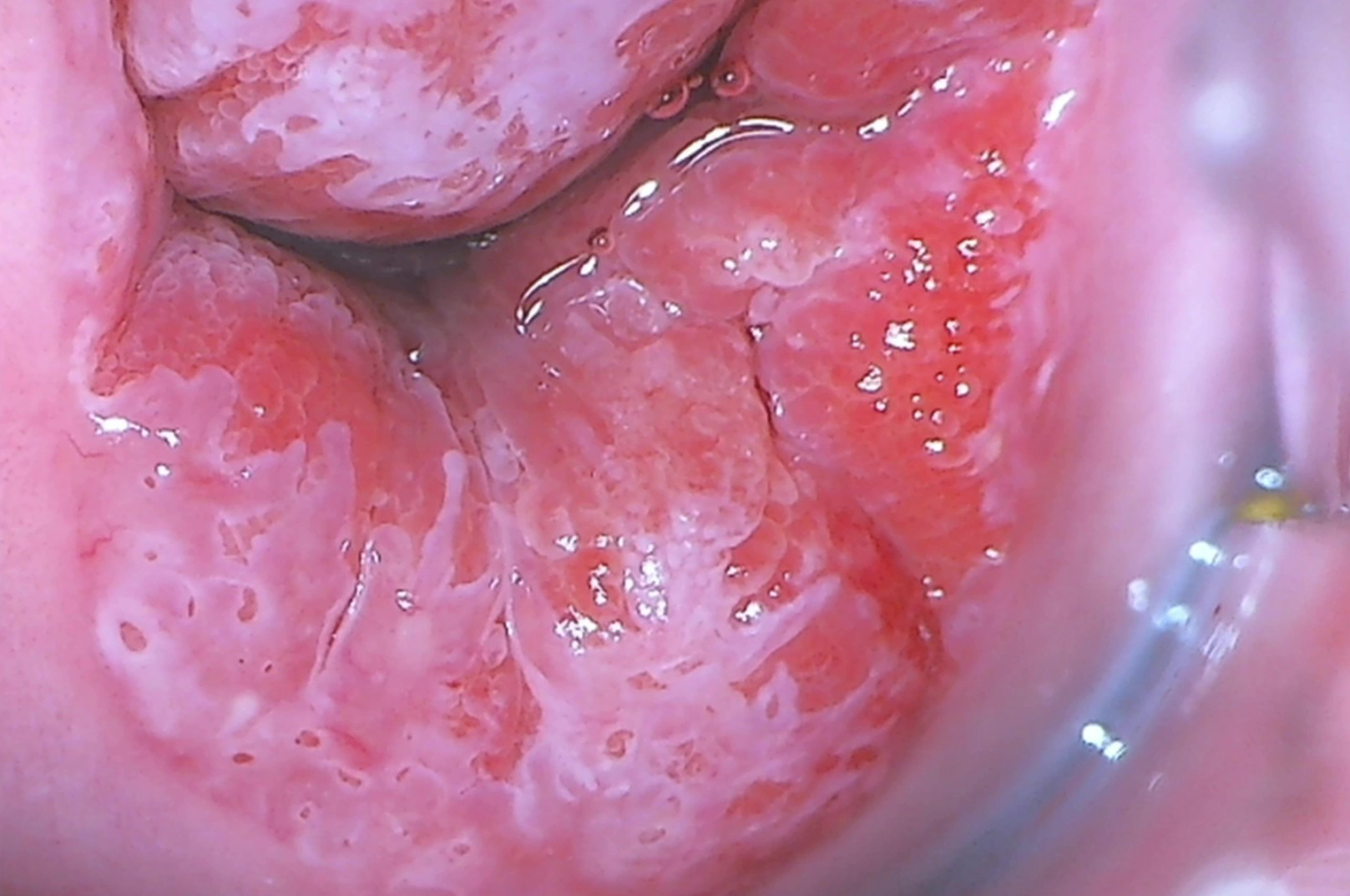 Как распознать метапластический эпителий?