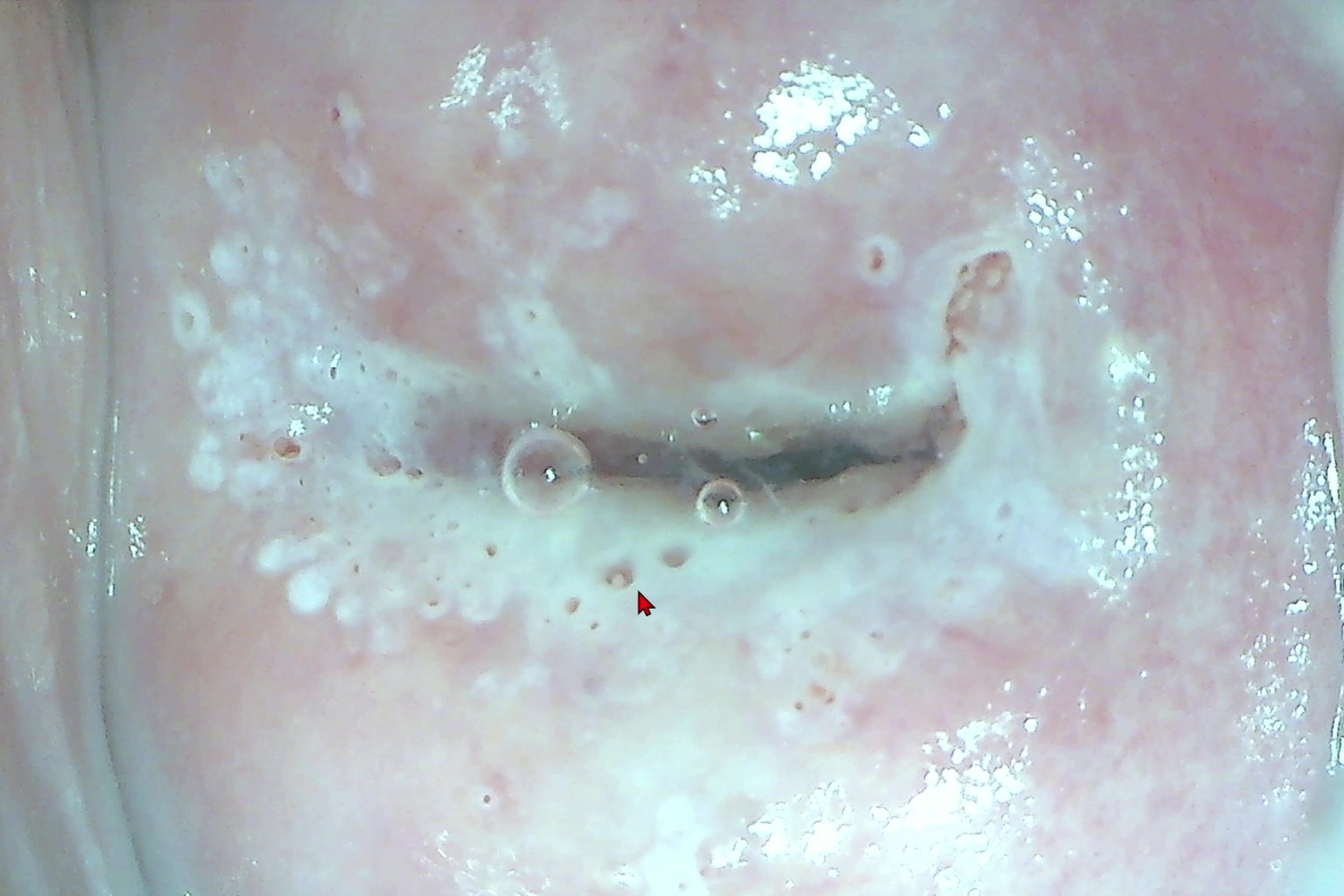 Открытые и закрытые железы на шейке матки: патология и норма