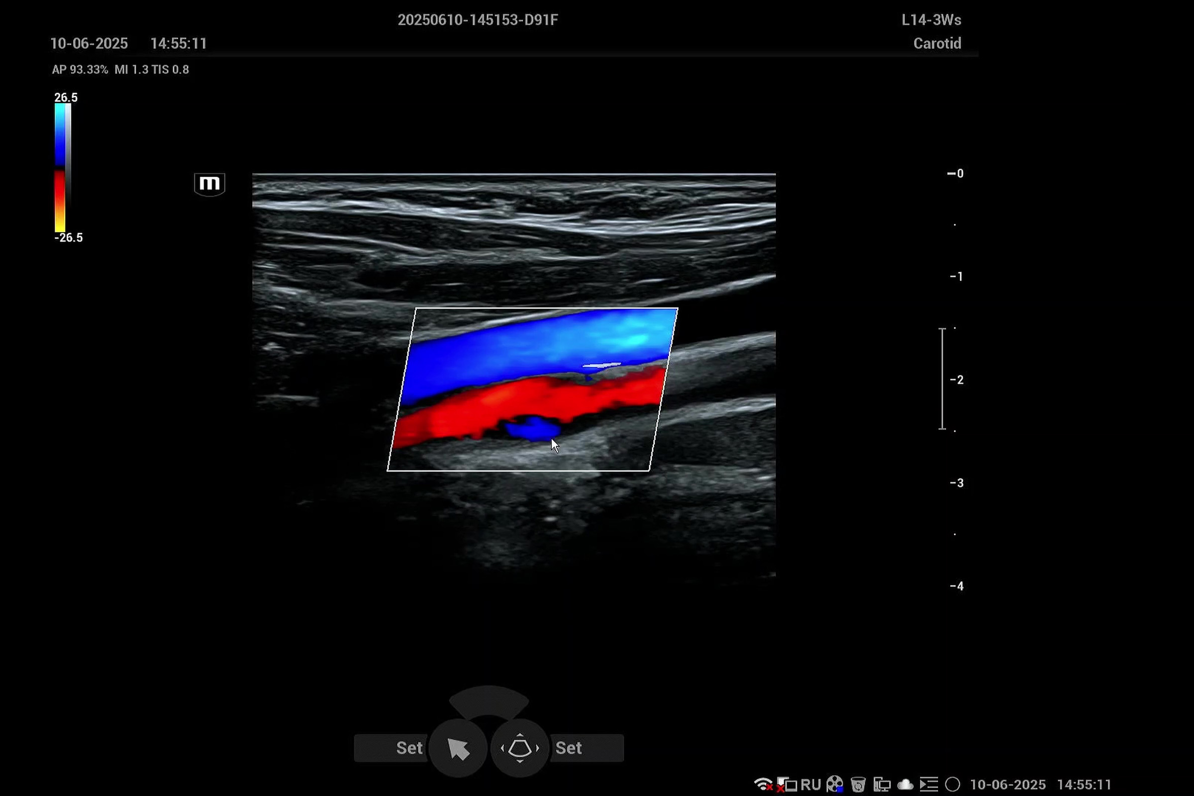 Как настроить режим B-Flow на аппаратах Mindray?
